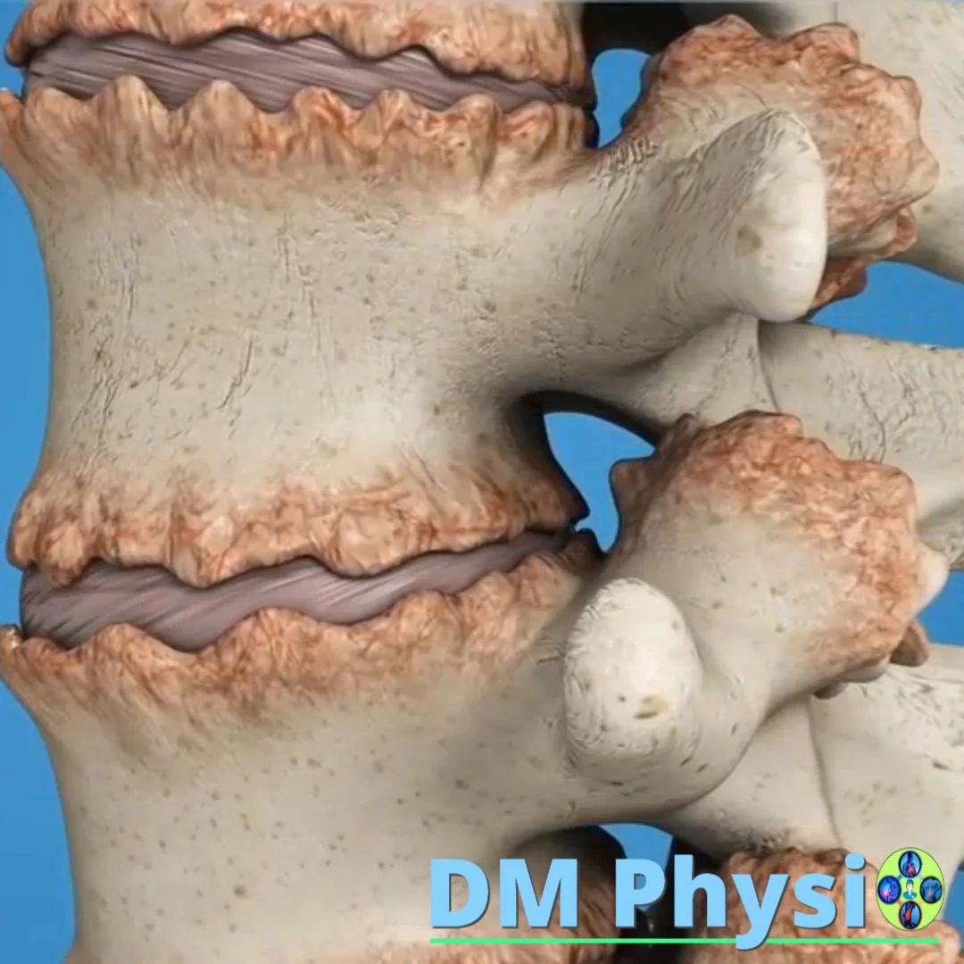 Шипове (остеофити) в кръстната област – визуализация